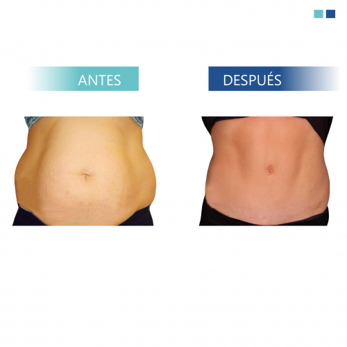 Abdominoplastia